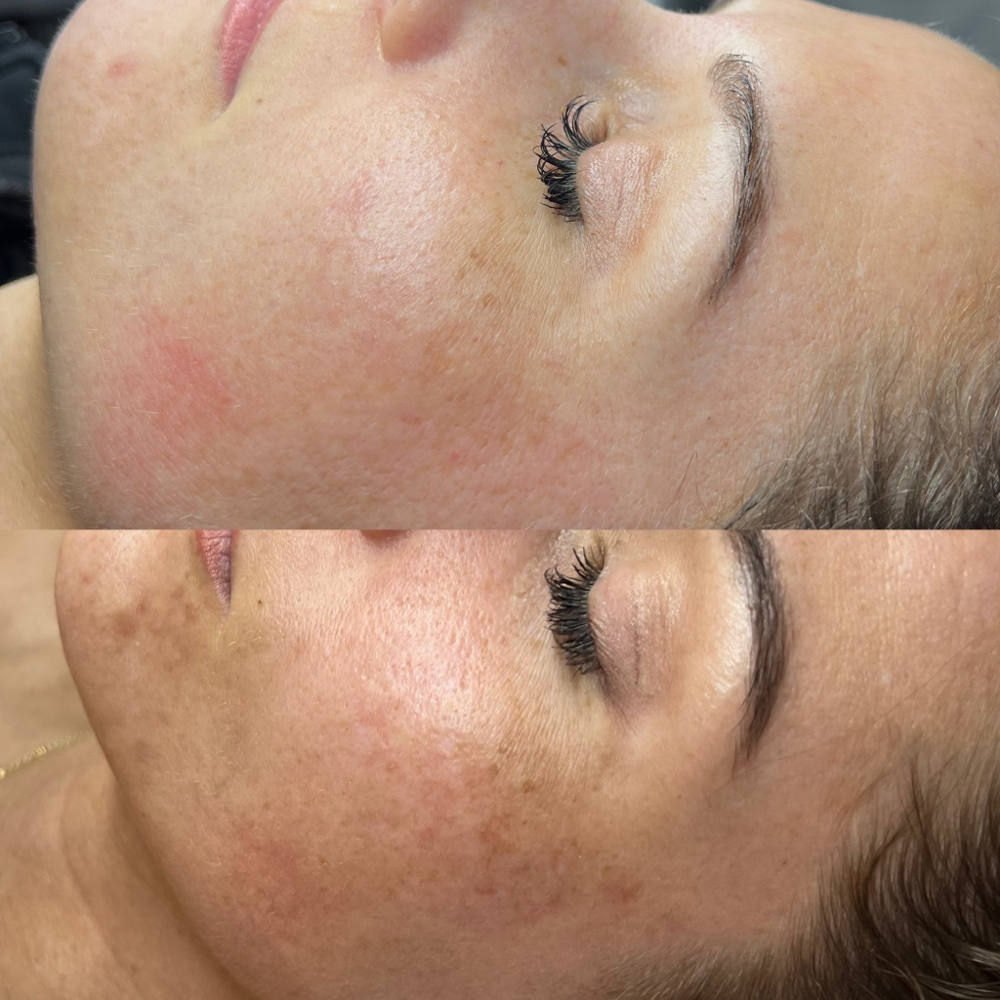 Chemical Peel