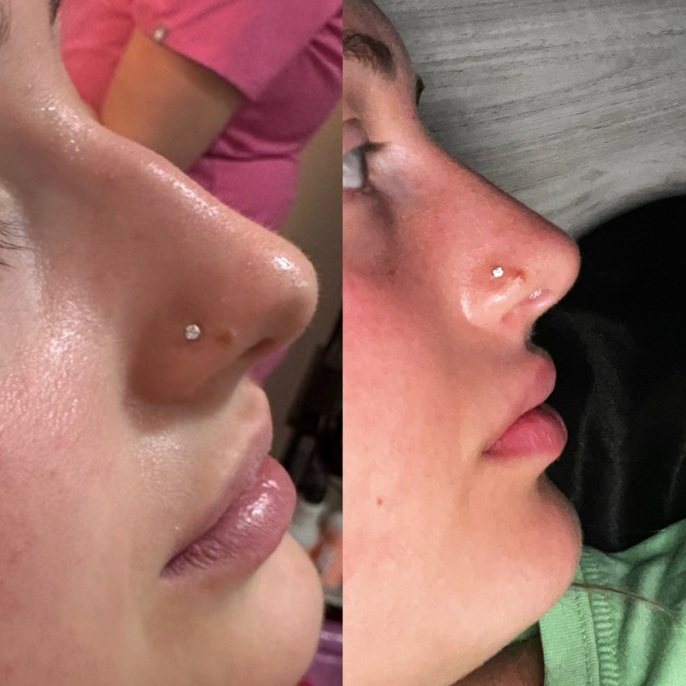 Non-Surgical Nose Job