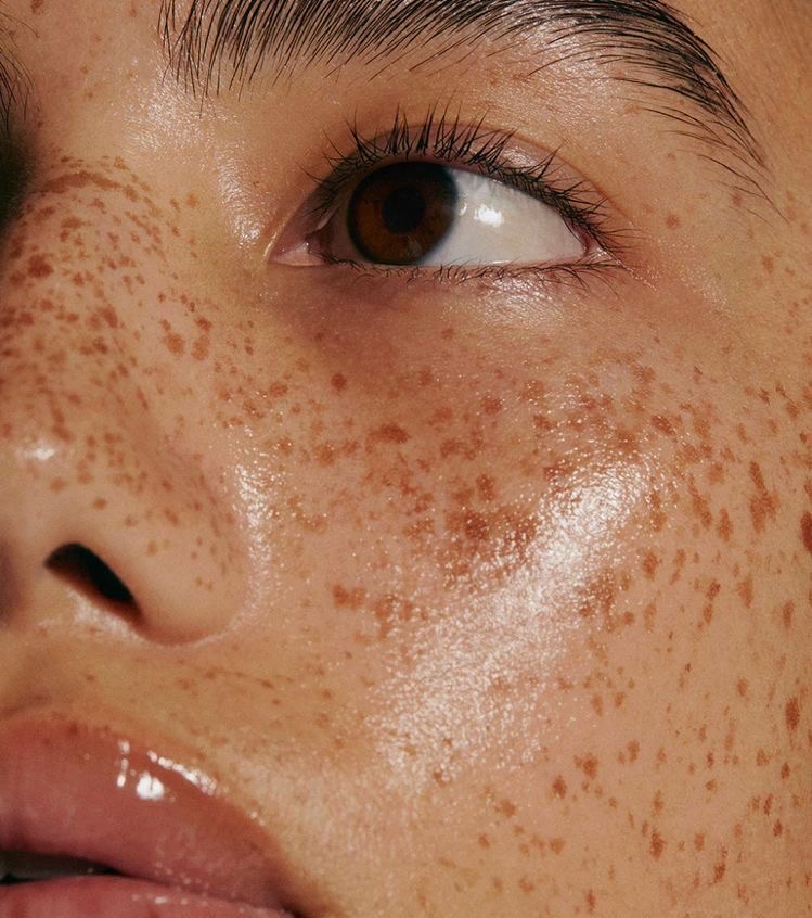 Permanent Freckles