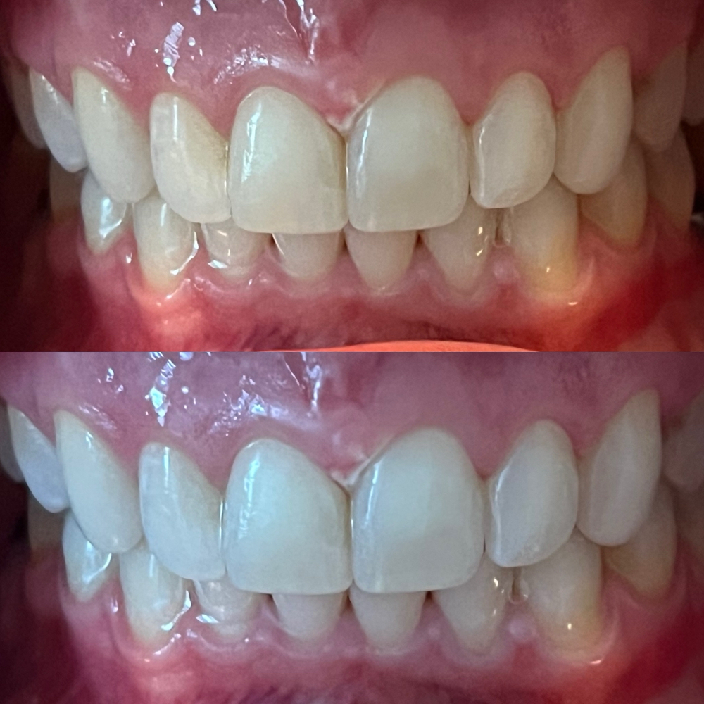 Teeth Whitening by Chelsea