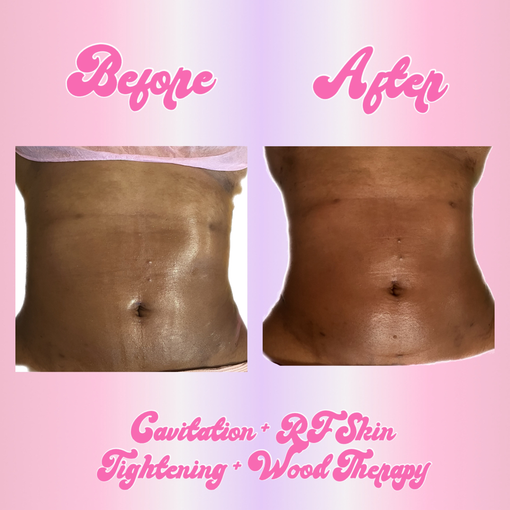 Cavitation/Wood Combo