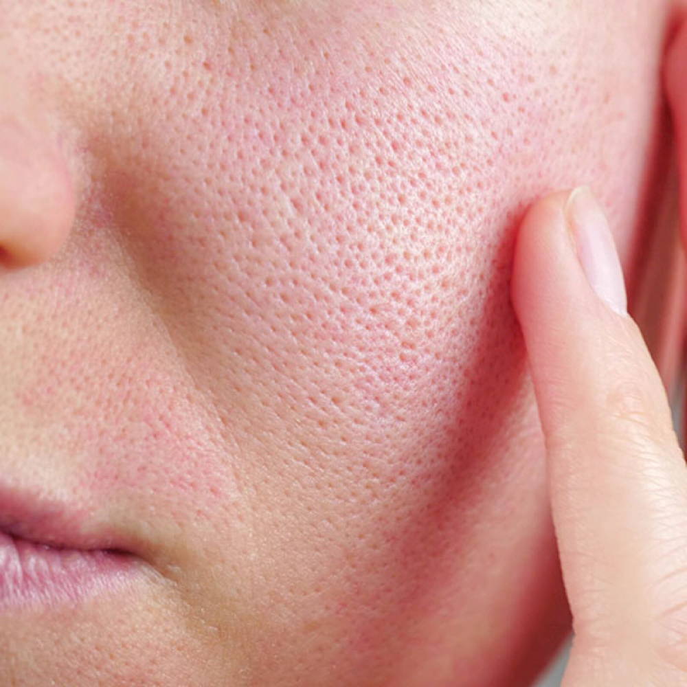Pore Refining + Texture Facial at Aesthetics by Abby in Alliance, OH