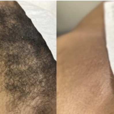 Brazilian Wax at J Esthetics in Homewood, IL