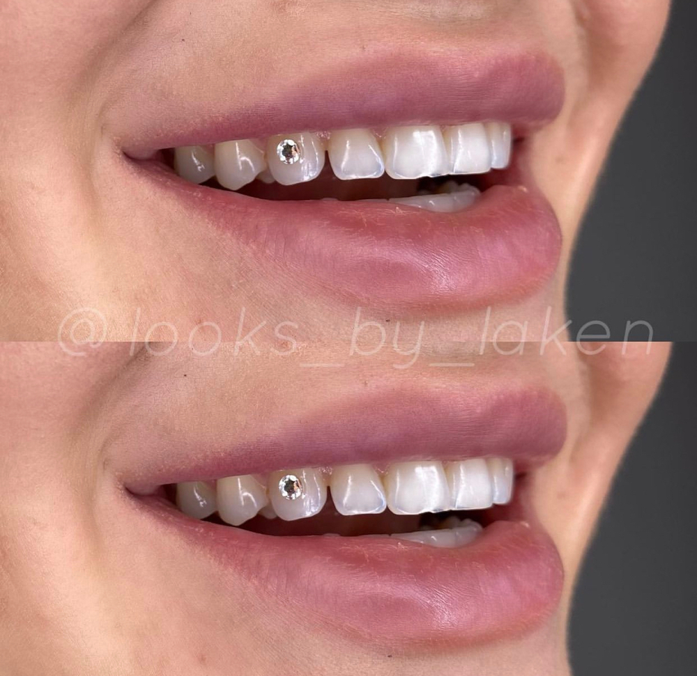 Tooth Gem (1)
