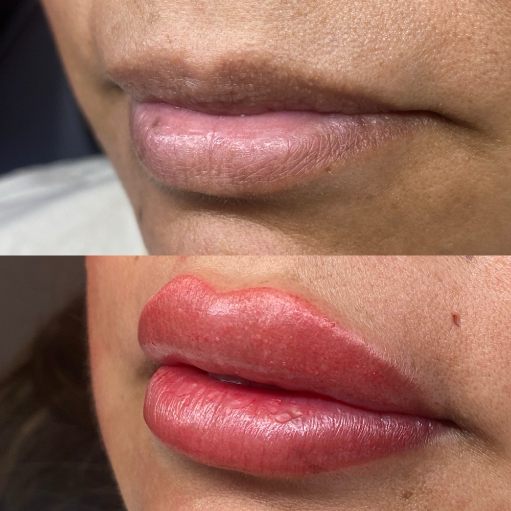 Lip- Yearly Touchup/Refinement