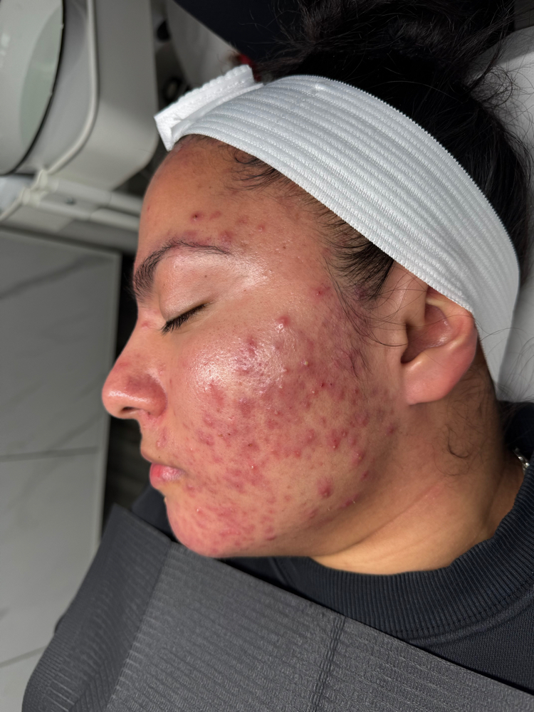 Acne Y Sus Manifestaciones Presenci