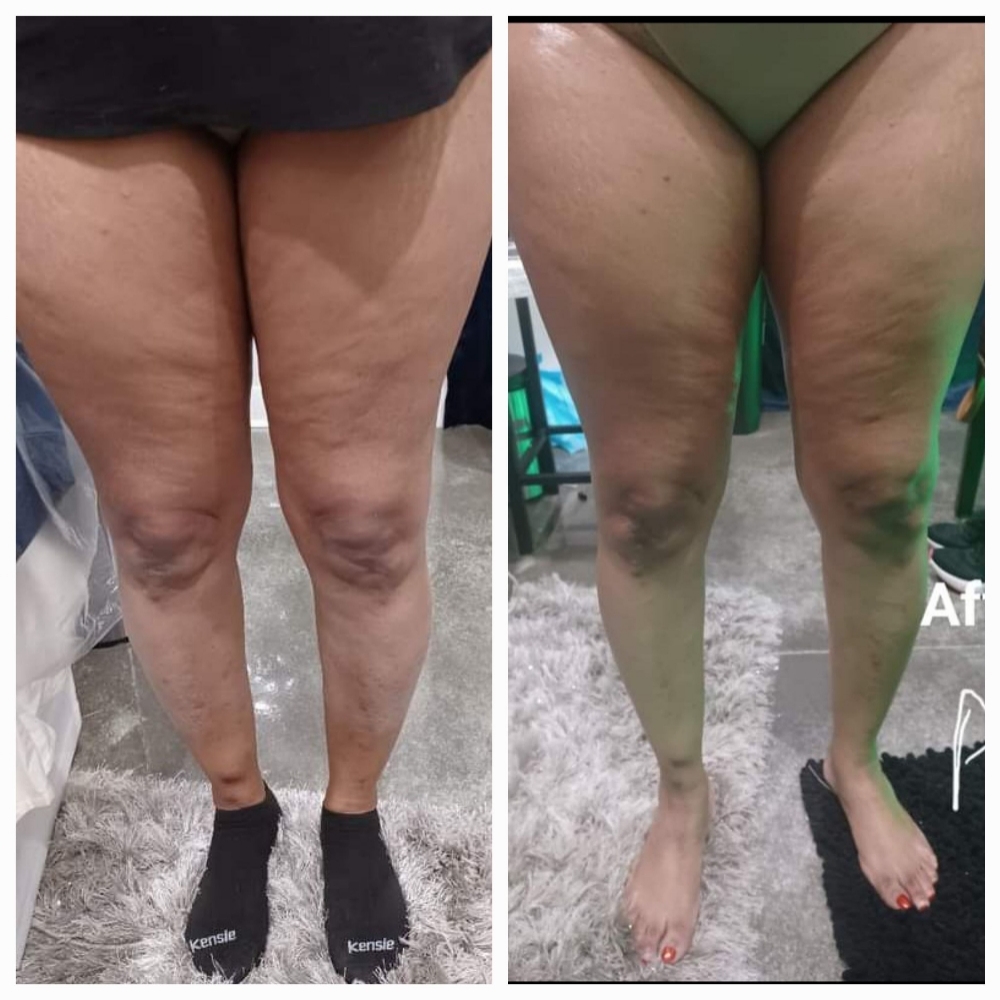 Cellulite Reduction at JUST BEAUTIFUL SKIN in Goose Creek, SC