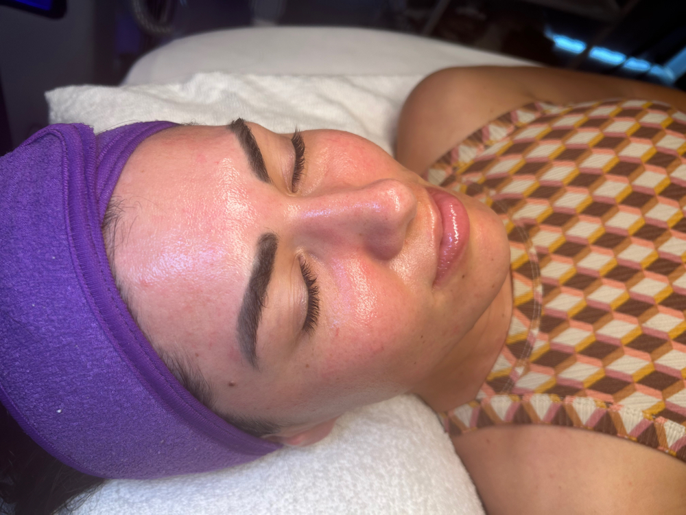 Microdermabraision