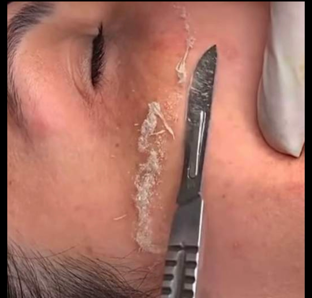 Dermaplaning