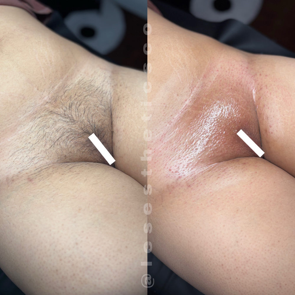 brazilian wax