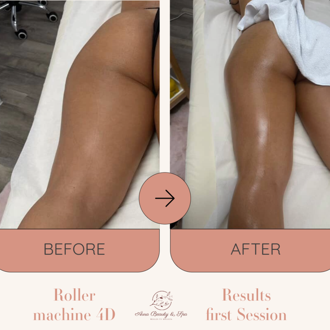Cellulite –  Roller Machine 4D