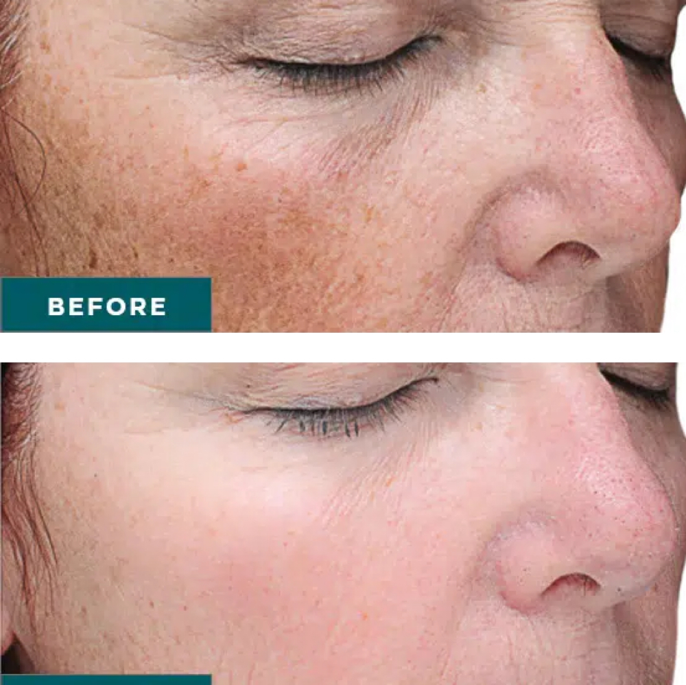 VI Chemical Peel + Peptides at Allure Aesthetics & Wellness Studio in Midwest City, OK