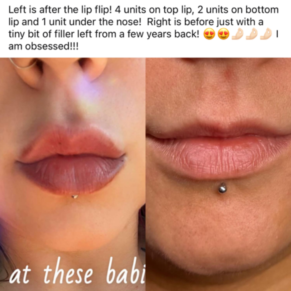 Lip Flip (botox) at Abigail Espinoza in Angleton, TX