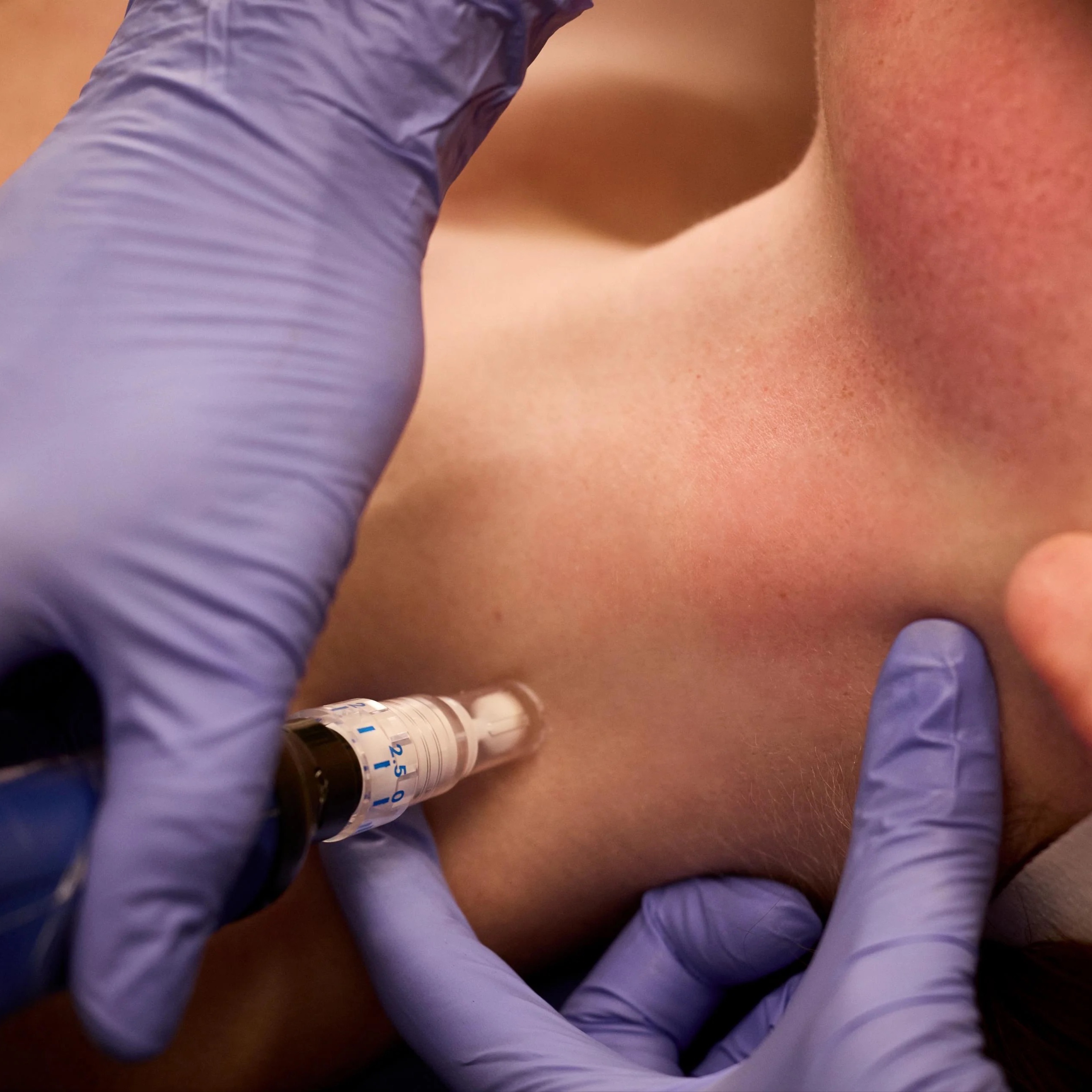 SkinPen Microneedling Face/Chest at The Skin Concierge in Northbrook, IL