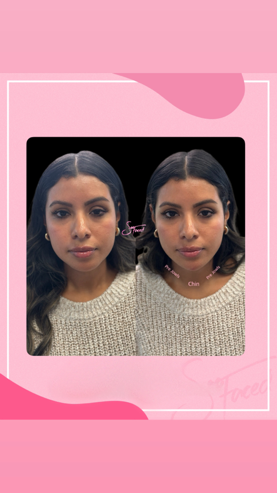 Chin Filler