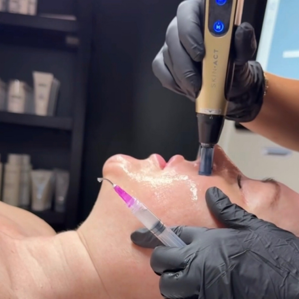 Nano-infusion Facial at Summer Lynn Aesthetics in NY, NY