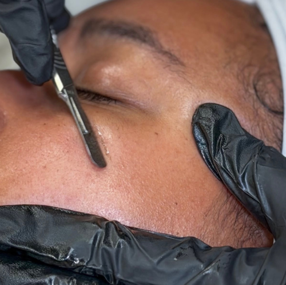 Dermalplaning Facial at Ressthetics in Poughkeepsie, NY