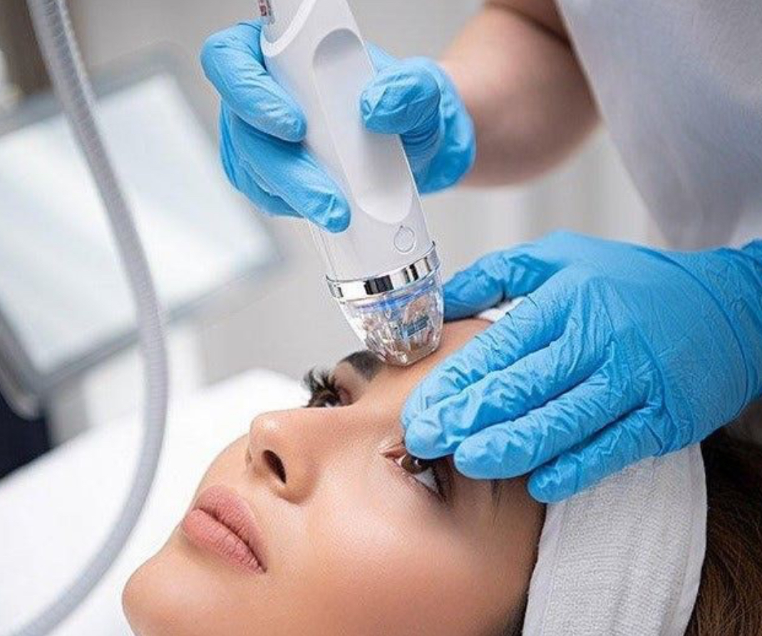 RF Microneedling Treatment