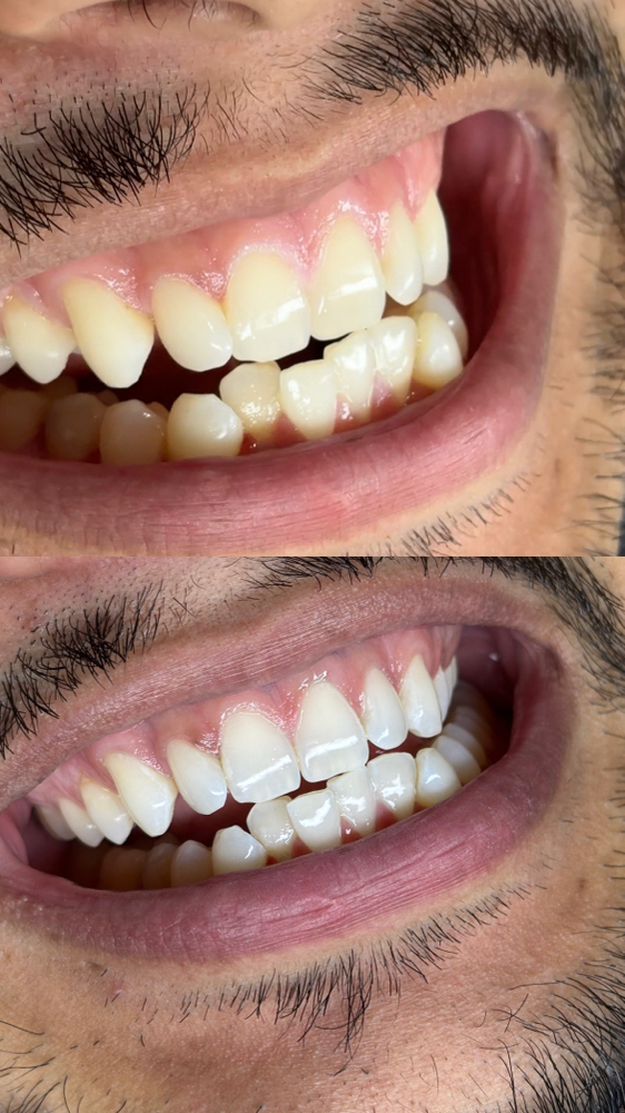 Teeth Whitening - 45 Mins