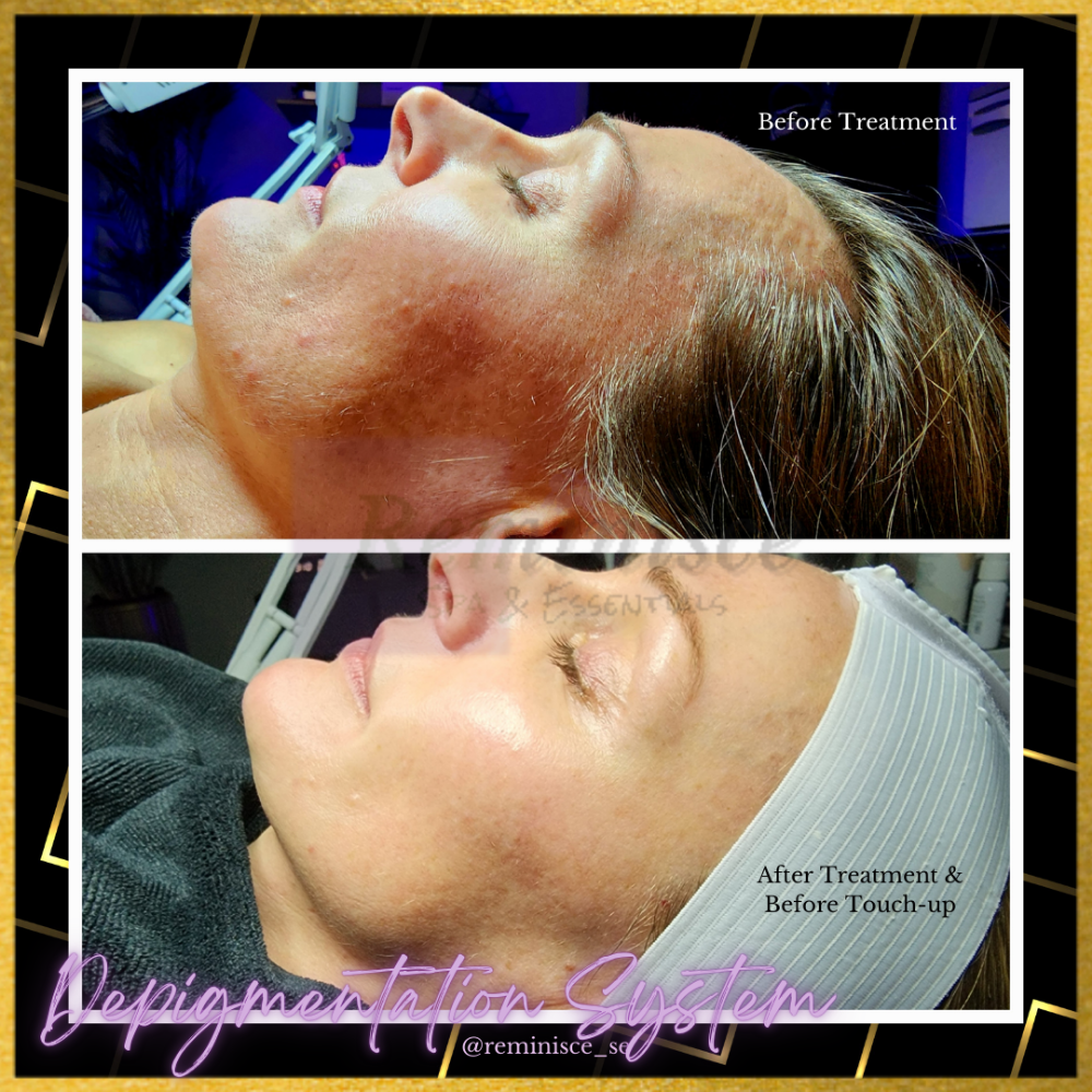 Depigmentation System
