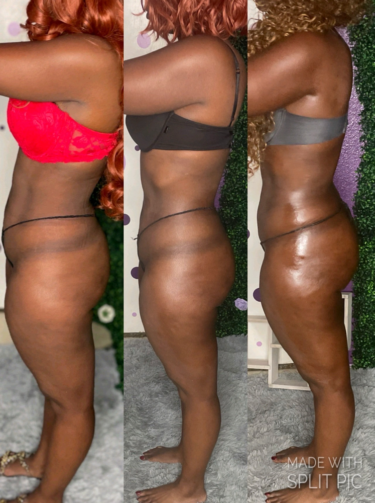 Non-surgical Lipo & skin Tight 60m