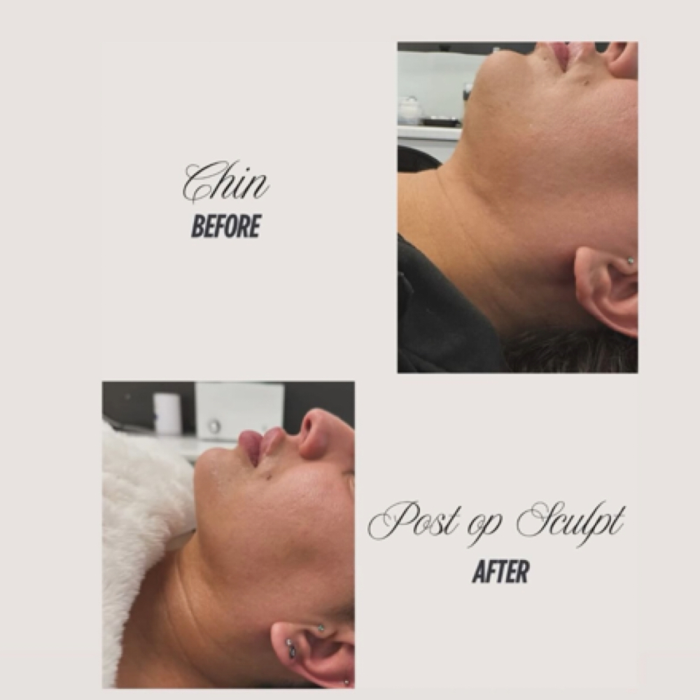 Radio Frequency Facial at Reona Spa in Gretna, LA