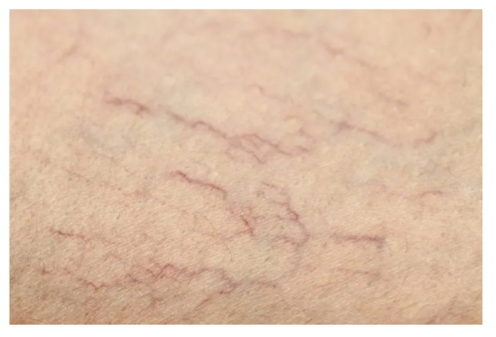 Spider Vein Treatment