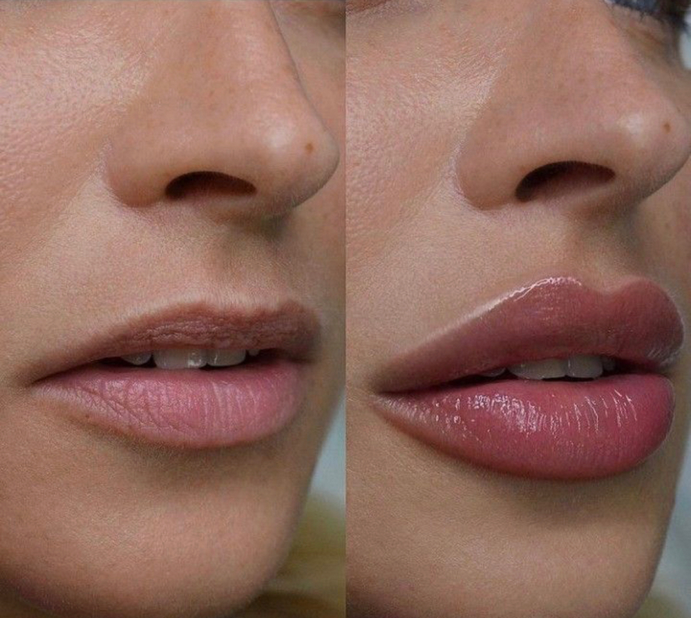 Lip Filler