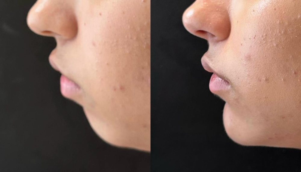Aumento De MENTON at Sashy Beauty Studio in Carolina, PR
