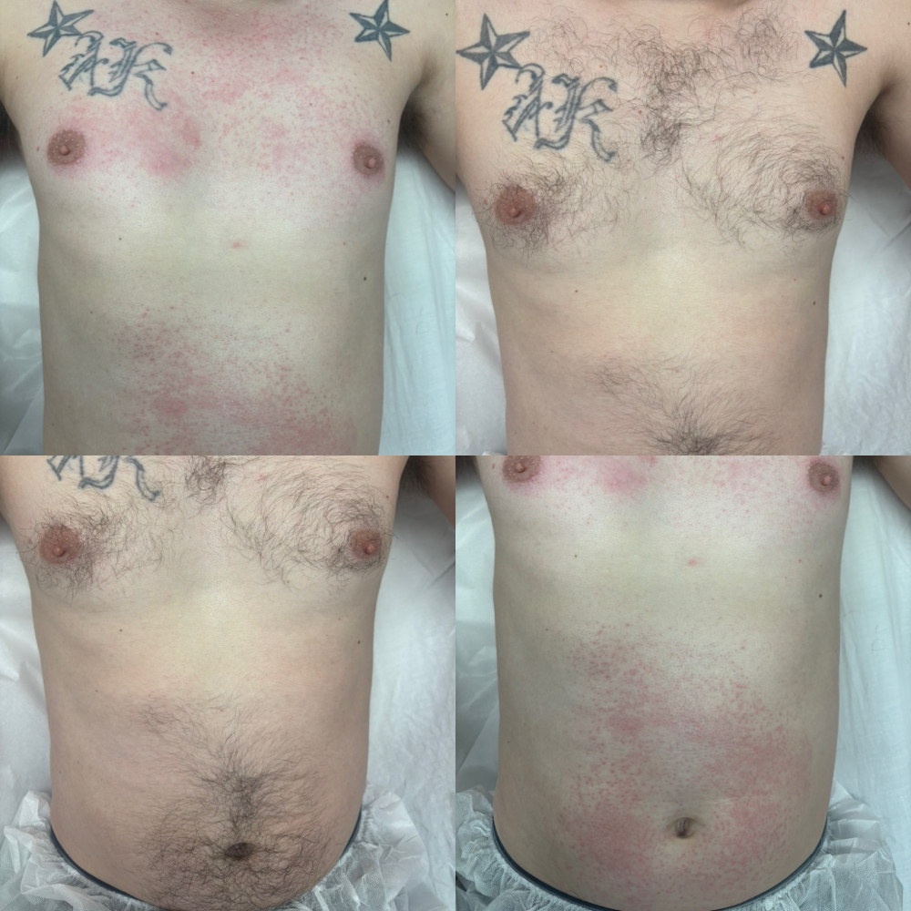 Chest Wax