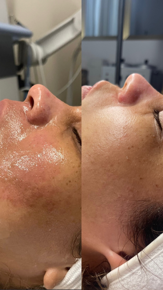 Chemical Peel