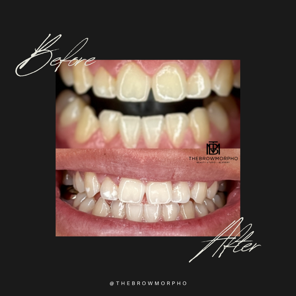 Teeth Whitening Packages