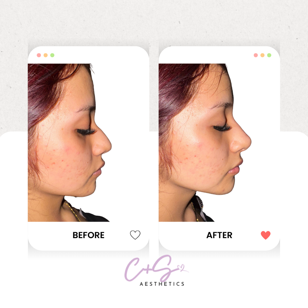 Liquid Rinoplasty