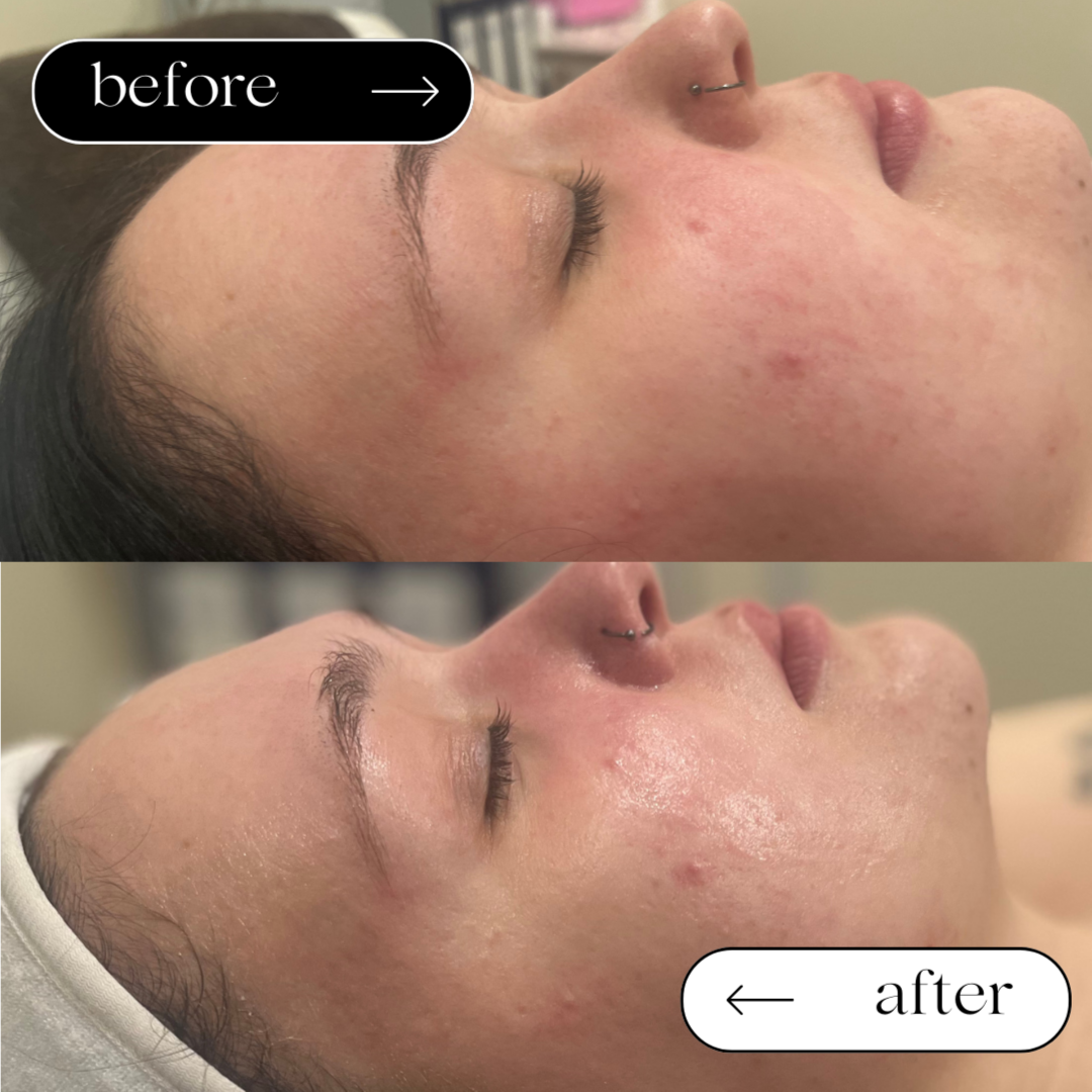 Winter Glow Facial at Glow Lab by Bronte in Springfield, IL