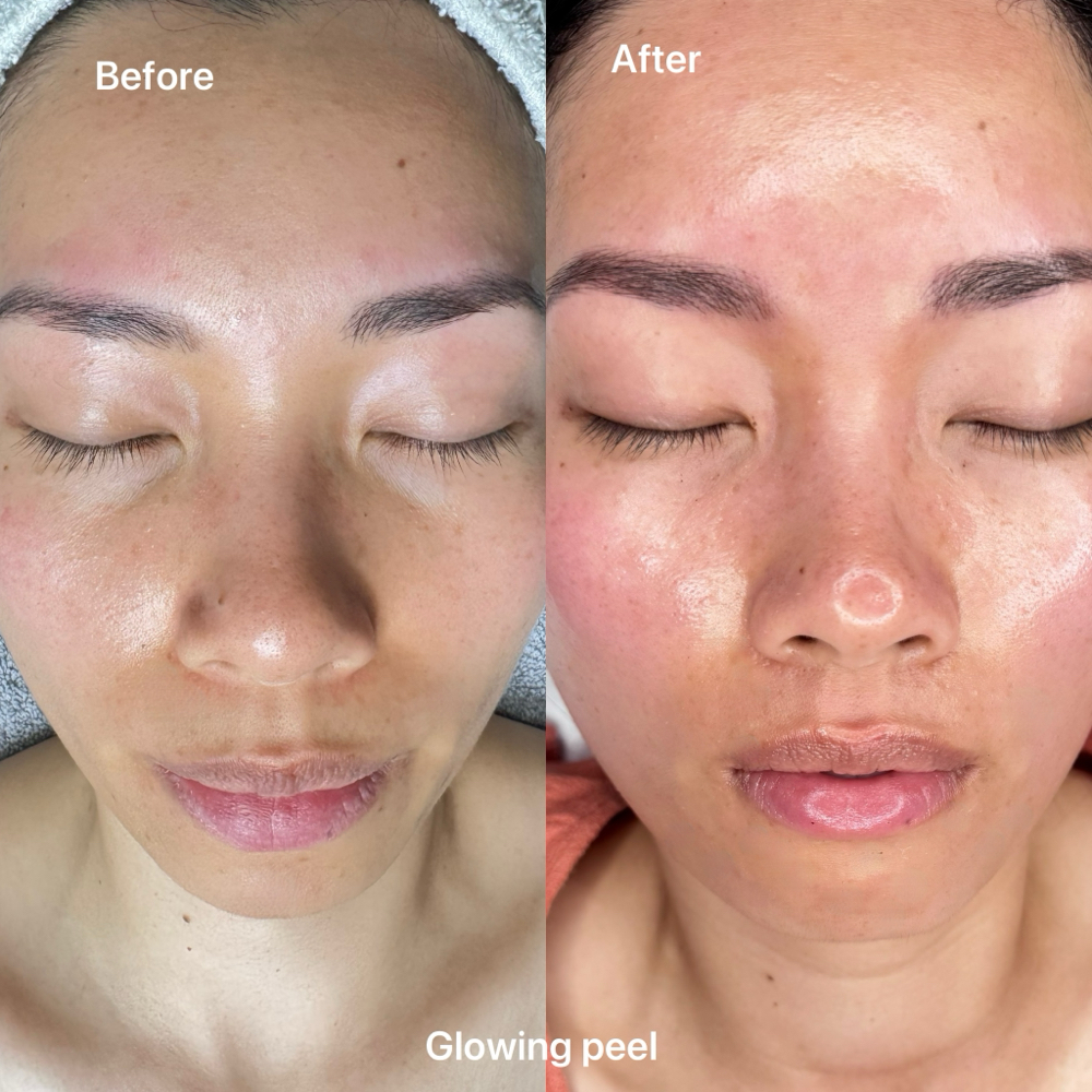 Glowing Peel Facial