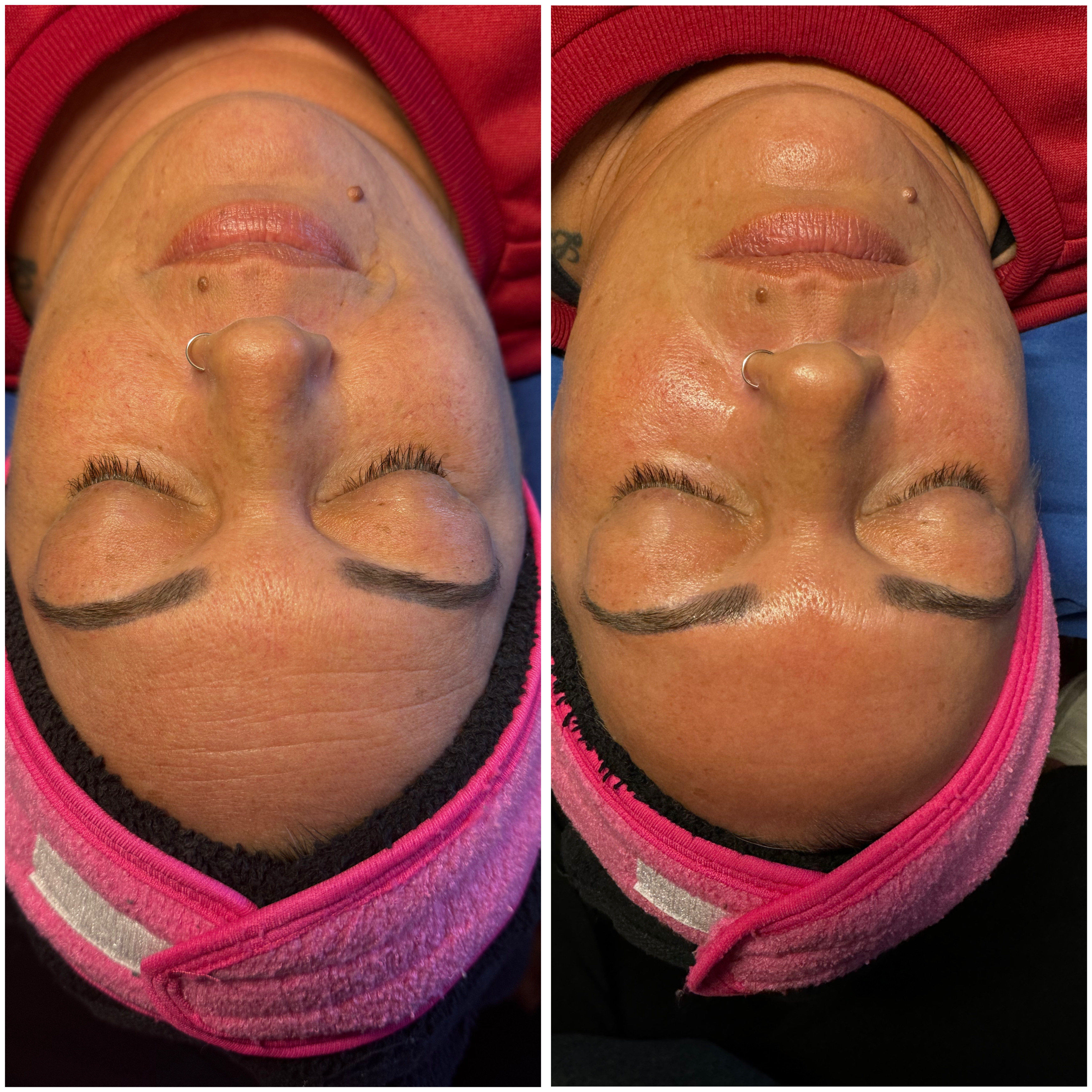 Dermaplaning Full Facial