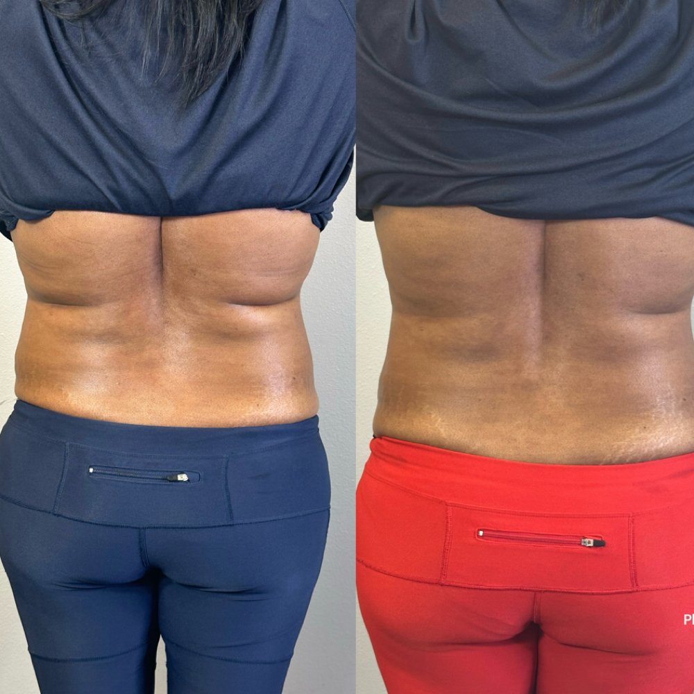 Back Sculpt (Cavitation) at Waxxaholics Beauty & Body in Grand Prairie, TX