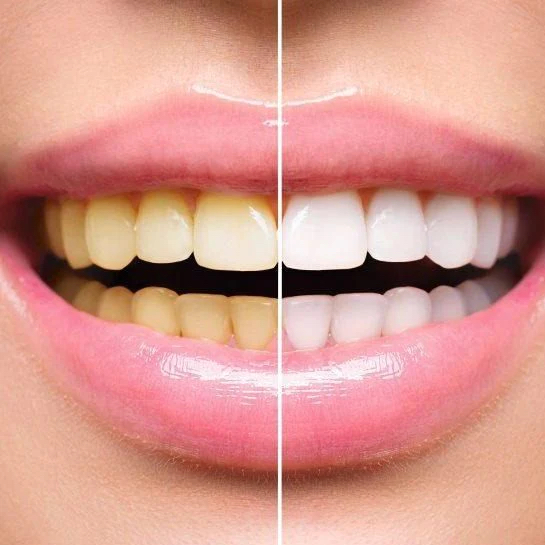 Teeth Whitening✨