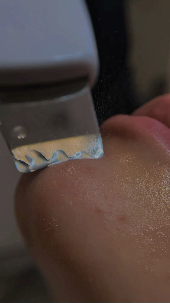 Acne Facial