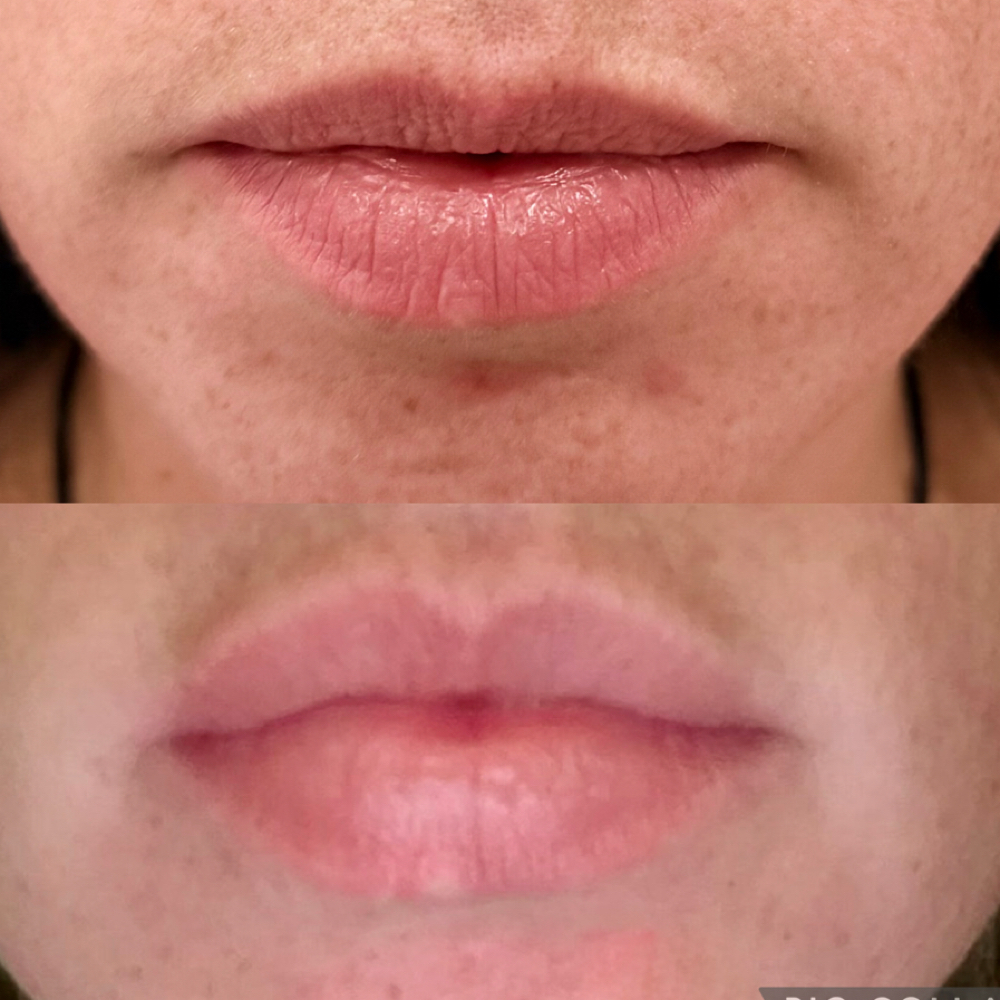 Lip Flip at Graceful A Beauty in Anna, TX