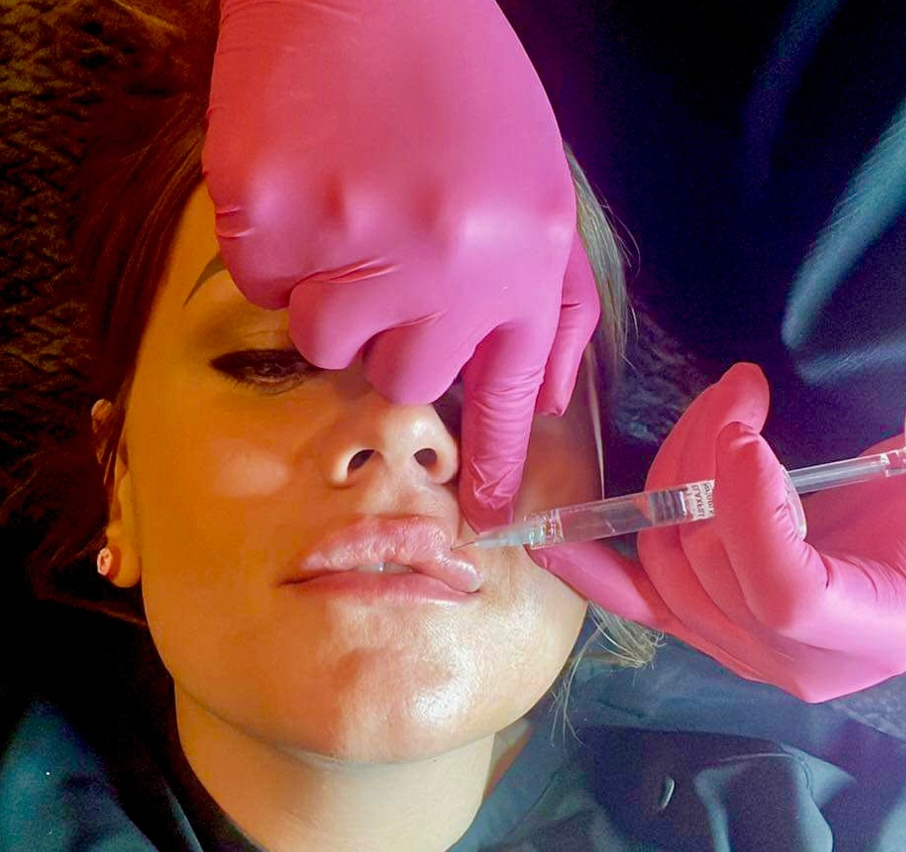 Filler-1/2 Syringe