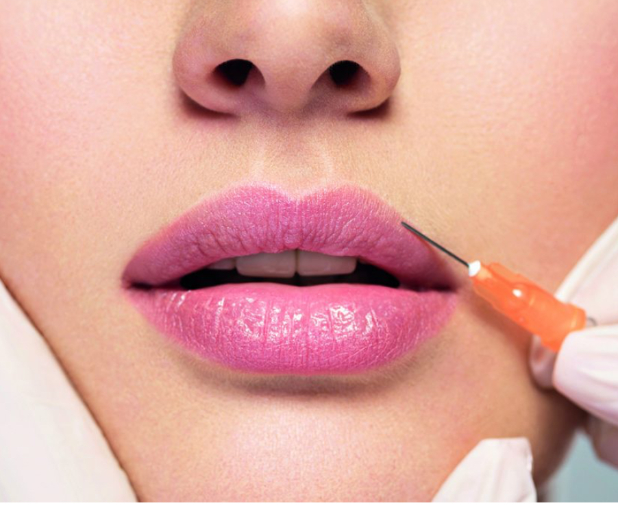 Lip Filler