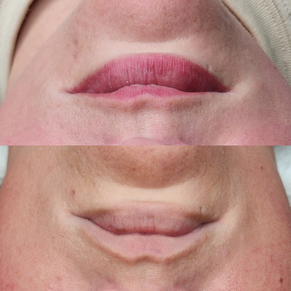 Permanent Lip Blush
