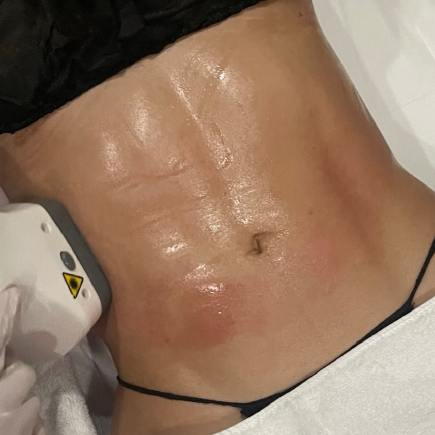 GOLDSAHPE ONE AREA at GOLD SKIN SPA AND BEAUTY in MCALLENT, TX