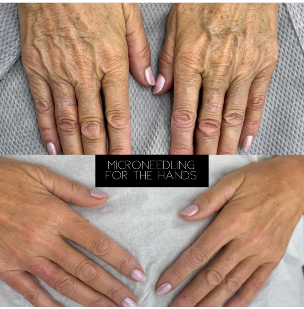 Hand MicroNeedle Permanent Anti Age at VINE Studios Permanent Cosmetics in Maple Valley Wa, WA