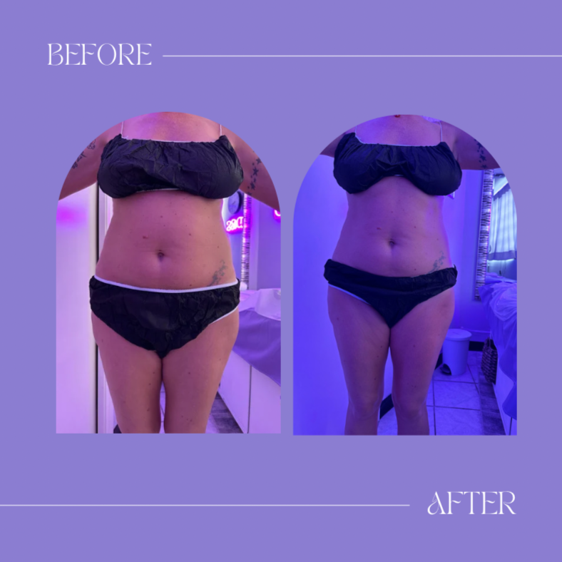 Luxe Contour Therapy(Up to 2 Areas) at O Beauty Services