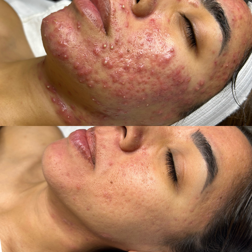 Acne Consultation with Treatment at Embody Beauty Studio in mcallen tx, TX