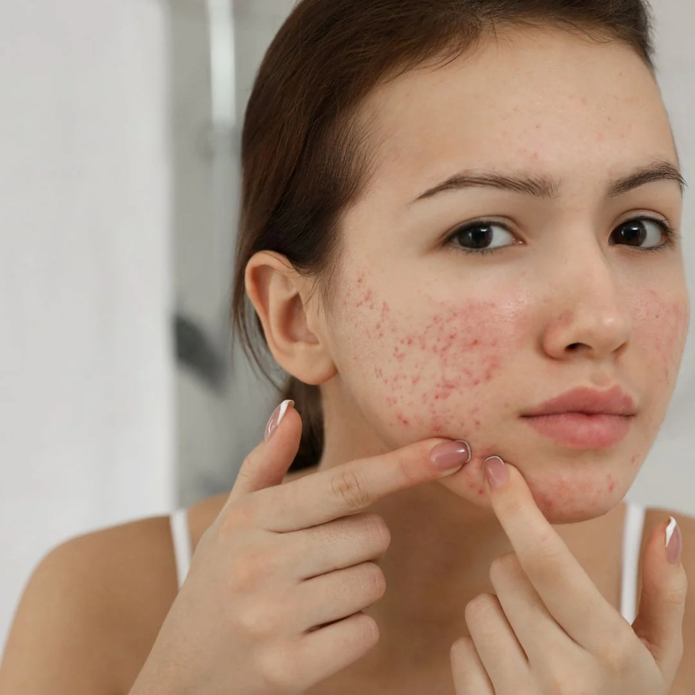 Teen Facial at No916SkinStudio in Sacramento, CA