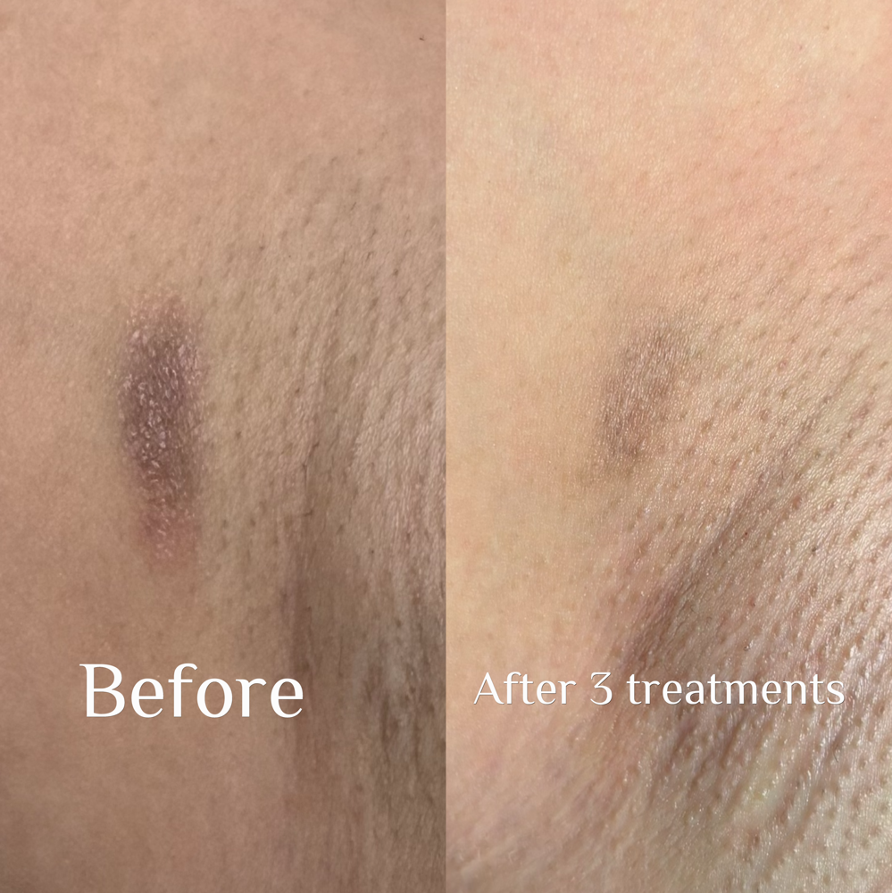 Brightening Treatment