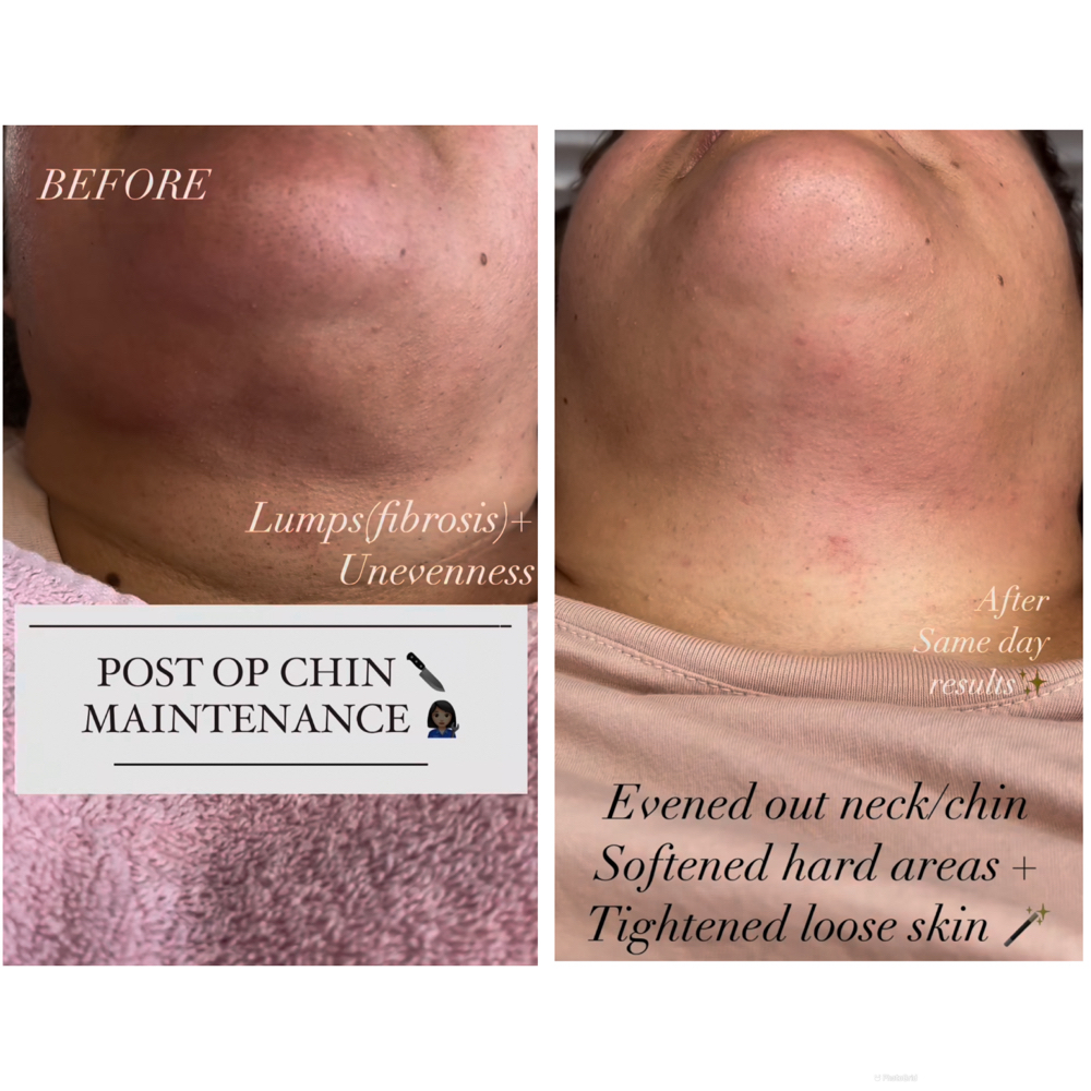 Post Op Chin Lipo Maintenance